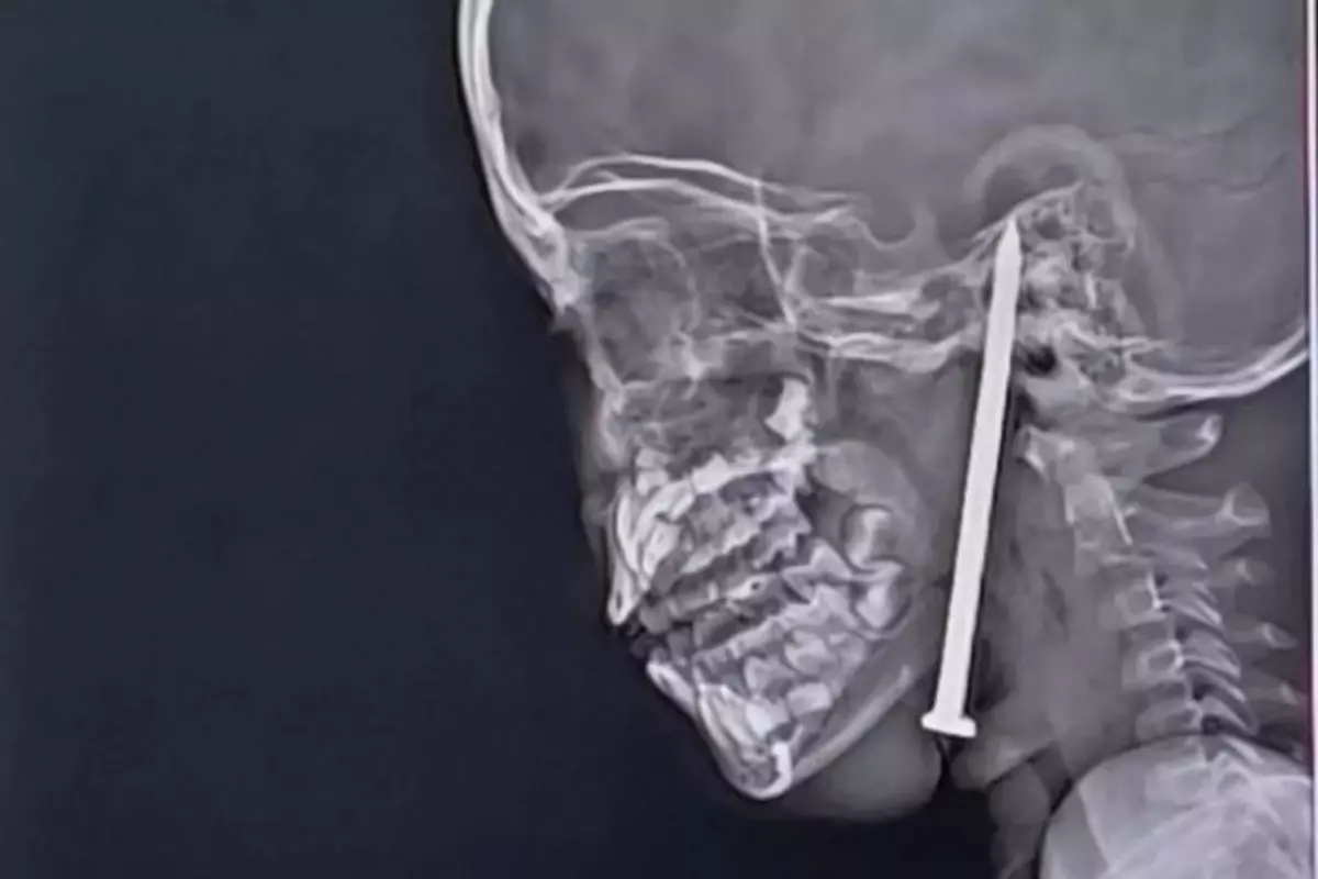 Beynine çivi saplanan küçük kız mucizevi şekilde kurtarıldı