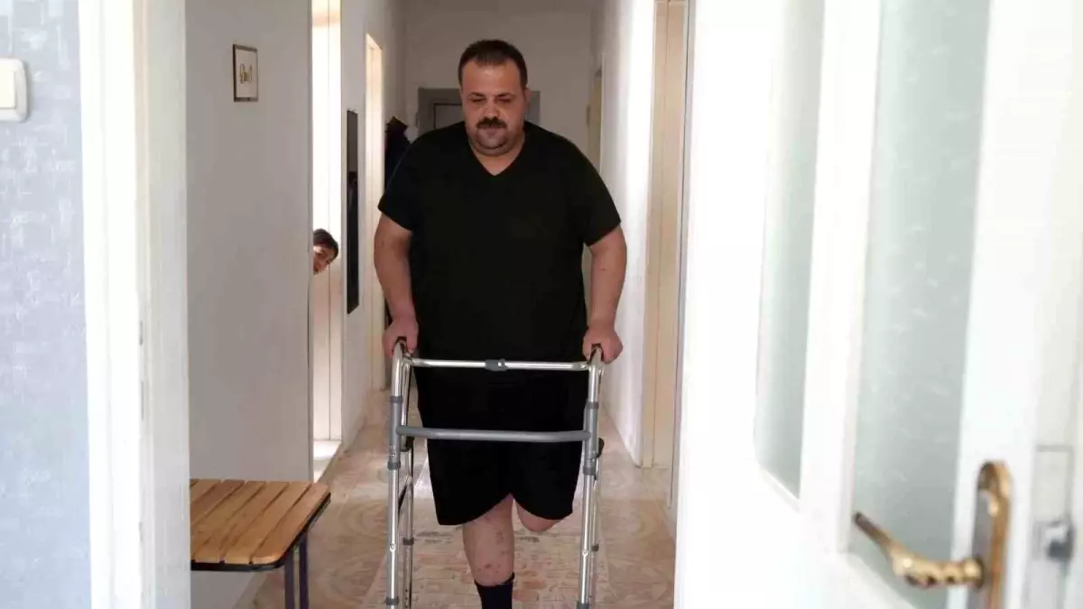 Yanlış Tedavi Sonucu Ayak Kesildi