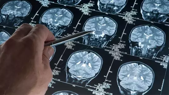 Alzheimer’a Erken Tespit İçin Yeni Kan Testi