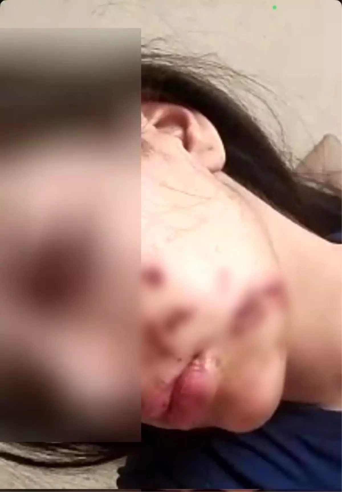Kurtalan'da Torpil Patladı, Genç Kız Yaralandı